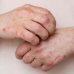 OMS advierte sobre alarmante aumento de casos de sarampión