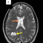 Hombre descubre que sus dolores de cabeza eran causados por un gusano en el cerebro