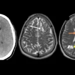 Migrañas eran en realidad gusanos en el cerebro por comer tocino mal cocido