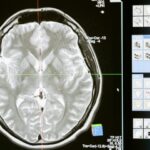 ¿Cómo saber si estás teniendo un infarto cerebral? Signos de alerta que debes conocer