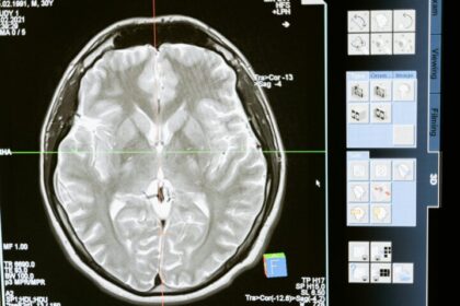 ¿Cómo prevenir un derrame cerebral en un 80%? Especialista lo explica